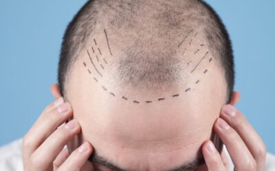 Trapianto capelli – Info e Costi dell’autotrapianto FUE E FUT