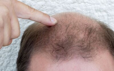 L’Hair Implant System e il Microautotrapianto FUE