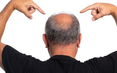 DNA e “geni della calvizie”