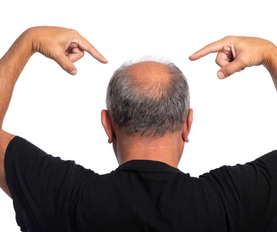 DNA e geni della calvizie