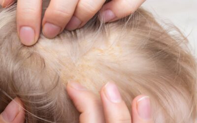 Dermatite seborroica, rimedi naturali