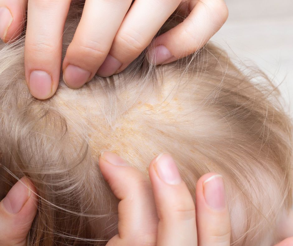 Dermatite seborroica